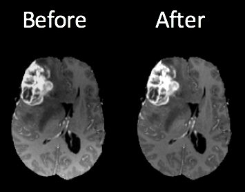 MRI before and after